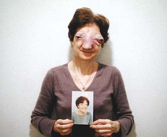 52歲法國婦人施碧兒罹患「嗅神經母細胞瘤」(法新社)
