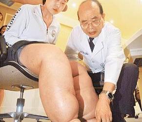 中國「象腿」女孩王程抵台就醫，昨由醫師檢查確定罹患慢性下肢淋巴水腫。